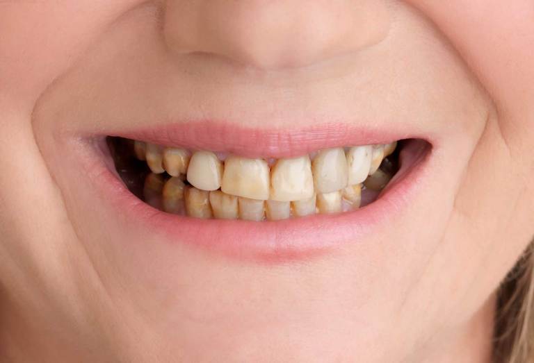 Life Smiles Dental Care La Jolla Snapon Smile